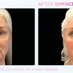 Emface before and after photo