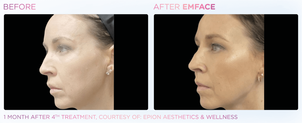 Emface before and after photo