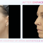 Emface before and after photo