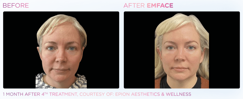Emface before and after photo