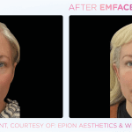 Emface before and after photo