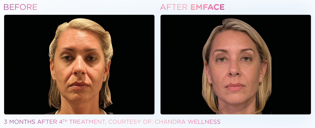Emface before and after photo