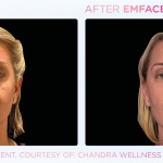 Emface before and after photo