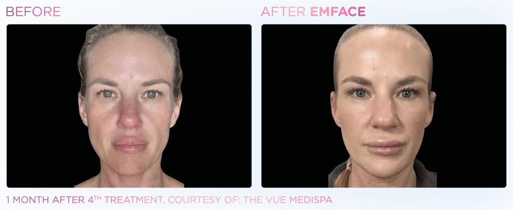 Emface before and after photo