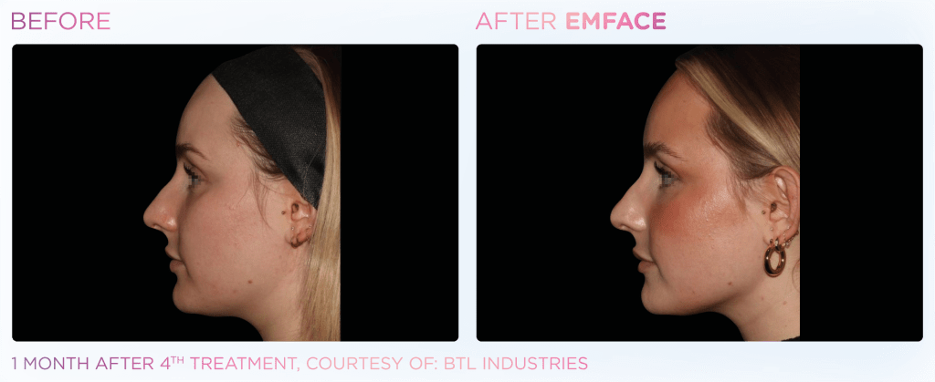 Emface before and after photo