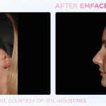 Emface before and after photo