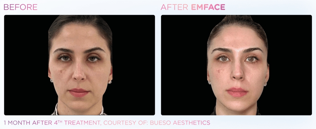 Emface before and after photo