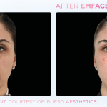 Emface before and after photo
