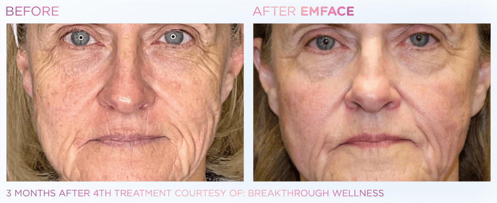 Emface before and after photo