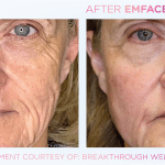 Emface before and after photo