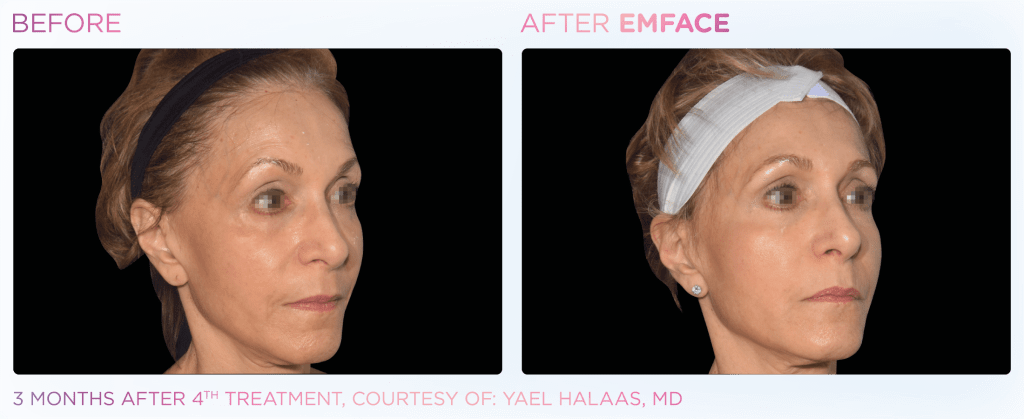 Emface before and after photo