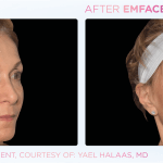 Emface before and after photo