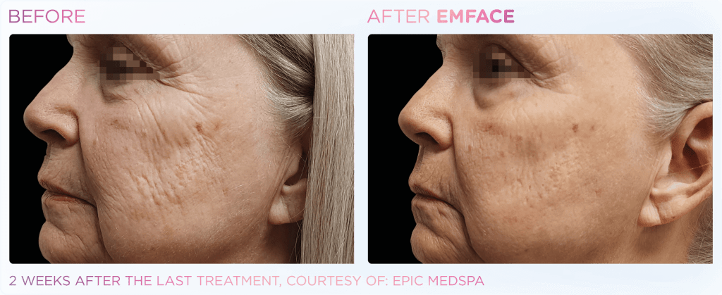 Emface before and after photo