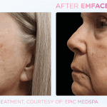 Emface before and after photo