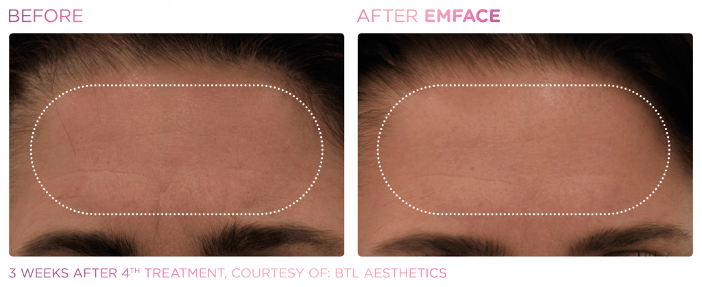 Emface before and after photo