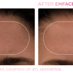 Emface before and after photo