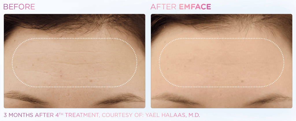 Emface before and after photo