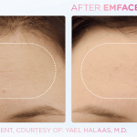 Emface before and after photo