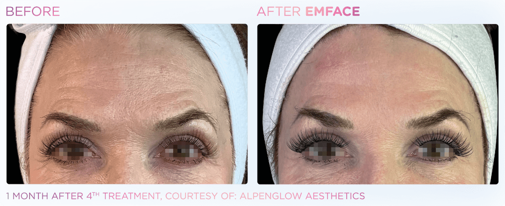 Emface before and after photo