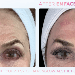 Emface before and after photo
