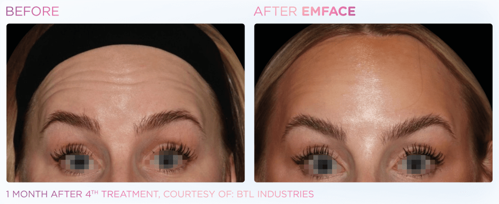 Emface before and after photo