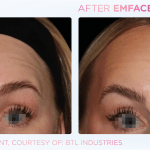 Emface before and after photo