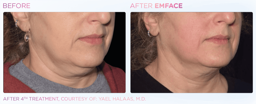 Emface before and after photo