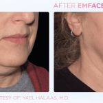 Emface before and after photo