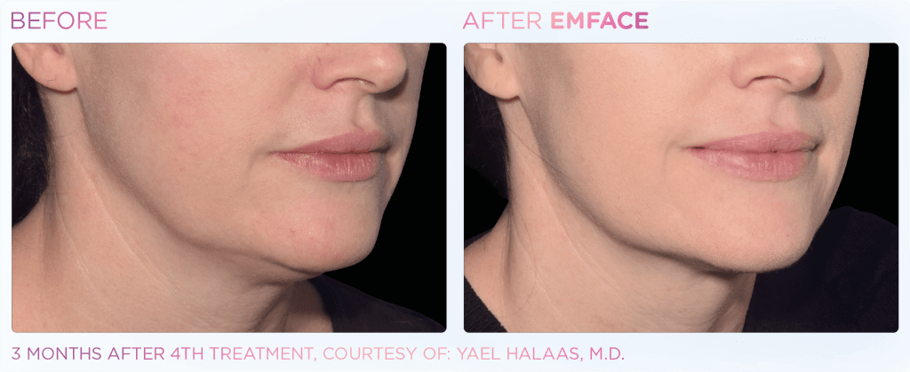 Emface before and after photo