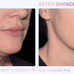 Emface before and after photo