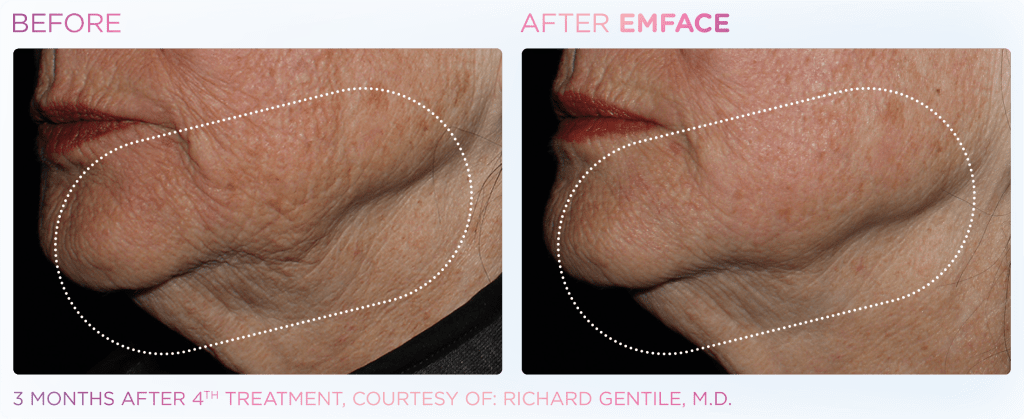 Emface before and after photo