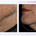 Emface before and after photo
