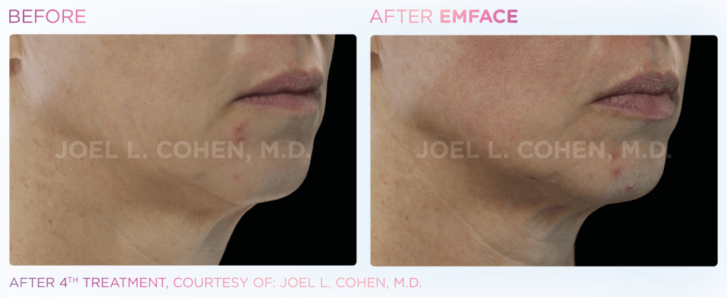 Emface before and after photo