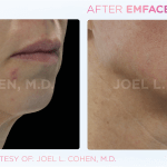 Emface before and after photo