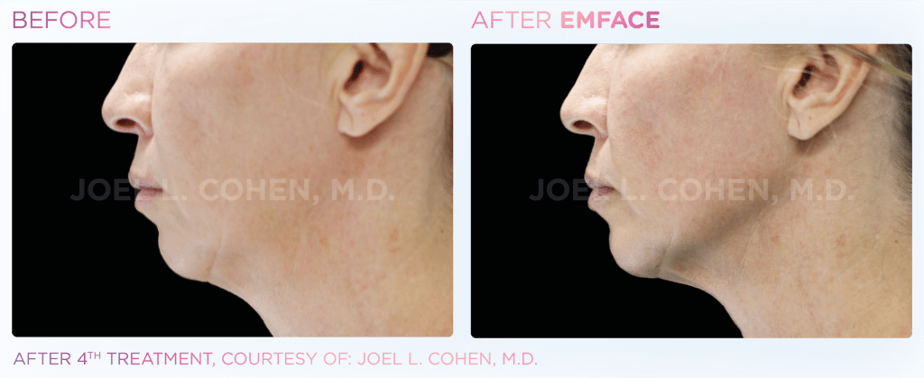 Emface before and after photo