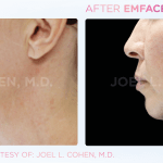 Emface before and after photo