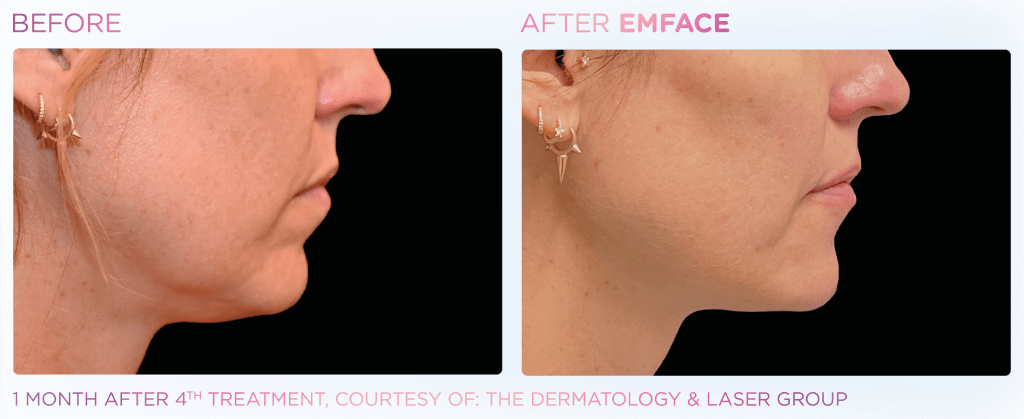 Emface before and after photo