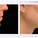 Emface before and after photo