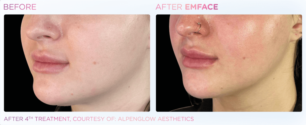 Emface before and after photo