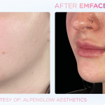 Emface before and after photo