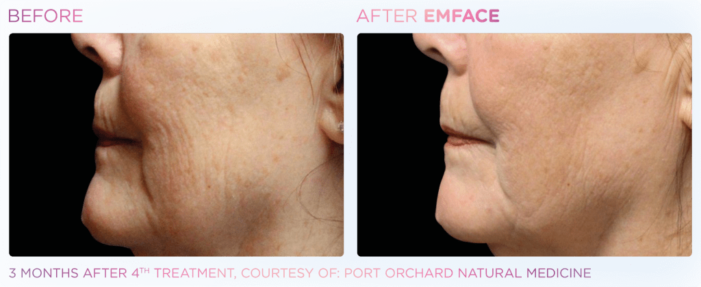 Emface before and after photo