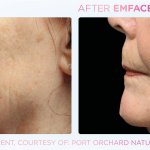 Emface before and after photo