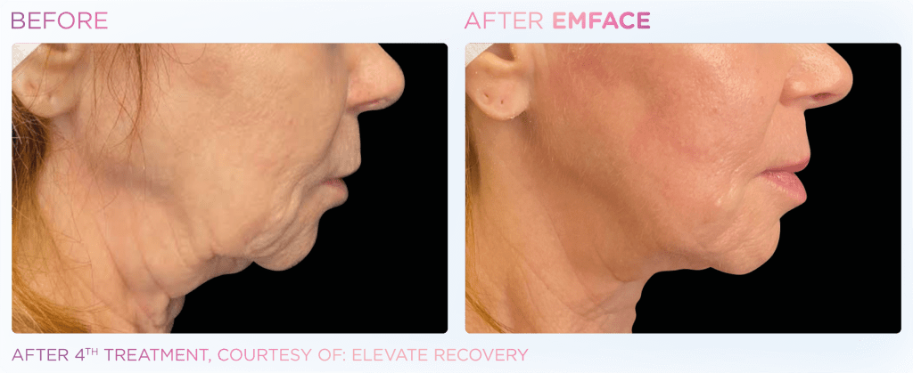 Emface before and after photo