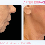 Emface before and after photo