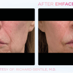 Emface before and after photo