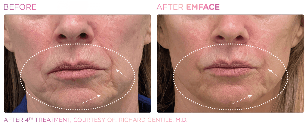 Emface before and after photo