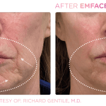 Emface before and after photo