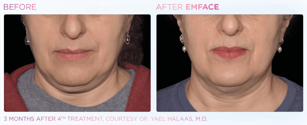 Emface before and after photo