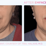 Emface before and after photo