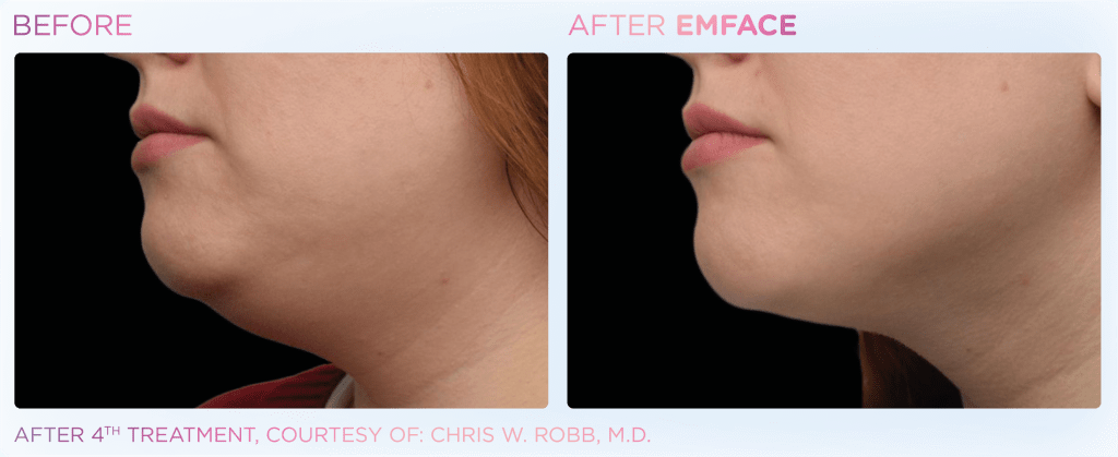 Emface before and after photo